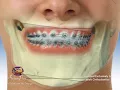 Download Lagu Mandibular Asymmetry