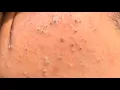 Part 1 Tag skincare removal blackheads