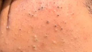 Part 1 Tag skincare removal blackheads