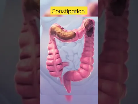 Download MP3 This is how constipation looks inside #viral #shortsvideo