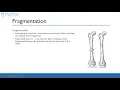 Online Tutorial Fractures Principles and Management Orthopaedics