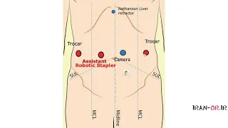 آموزش عمل جراحی اسلیو گاسترکتومی با دوبله فارسی 