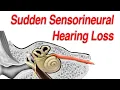 Sudden Sensorineural Hearing Loss Diagnosis Causes and Treatment