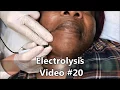Electrolysis on Darker skin type