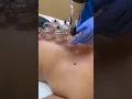 Cupping therapy for improving circulation