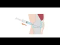 Aspiration bladder CPT code - simplify medical coding