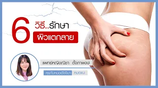  ผิวแตกลายหลังคลอดเกิดจากอะไร และมีวิธีป้องกันอย่างไรบ้าง 
