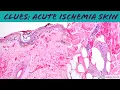 Dermpath Clues Acute Ischemia in Skin