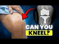 Can You Kneel After a Knee Replacement Yes - Here s How
