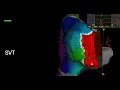 Accessory Pathway with Open Window Mapping