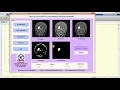 Matlab Code Brain Tumor Detection using Neural Network IEEE Project
