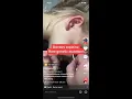 Doctor explains Rare genetic mutation