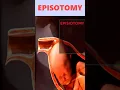 Episiotomy Surgical Incision