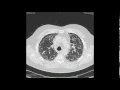 Axial chest high-resolution CT scan in a patient with idiopathic pulmonary fibrosis