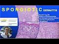 DERMATOPATHOLOGY Spongiotic Dermatitis