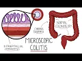 Download Lagu Microscopic Colitis (Lymphocytic \u0026 Collagenous Colitis) - An Underdiagnosed Form of IBD