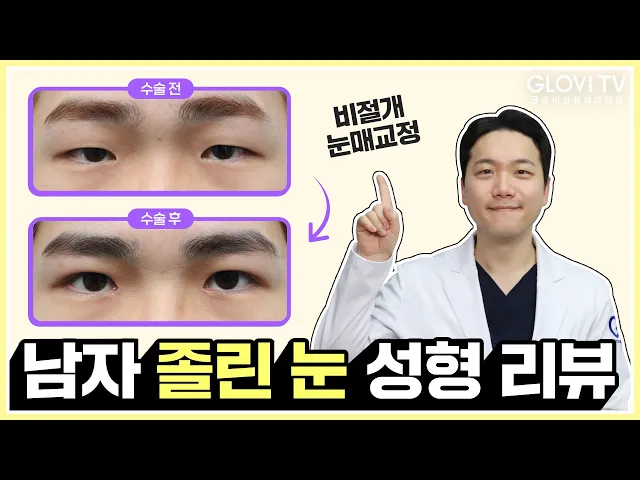 남자 비절개 눈매교정+앞트임 ✨ 눈 성형 리뷰📝
