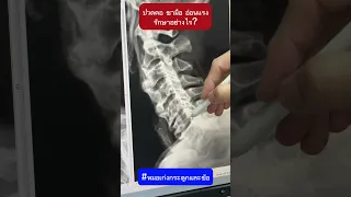  อาการปวดคอร้าวลงสะบักและแขนพร้อมกับนิ้วอ่อนแรงในผู้สูงอายุเกิดจากสาเหตุอะไร 