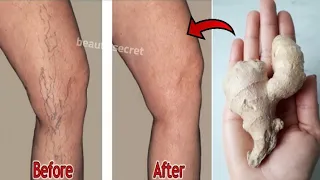 say goodbye to varicose veins and joint pain with only 2 natural ingredients 100 effective