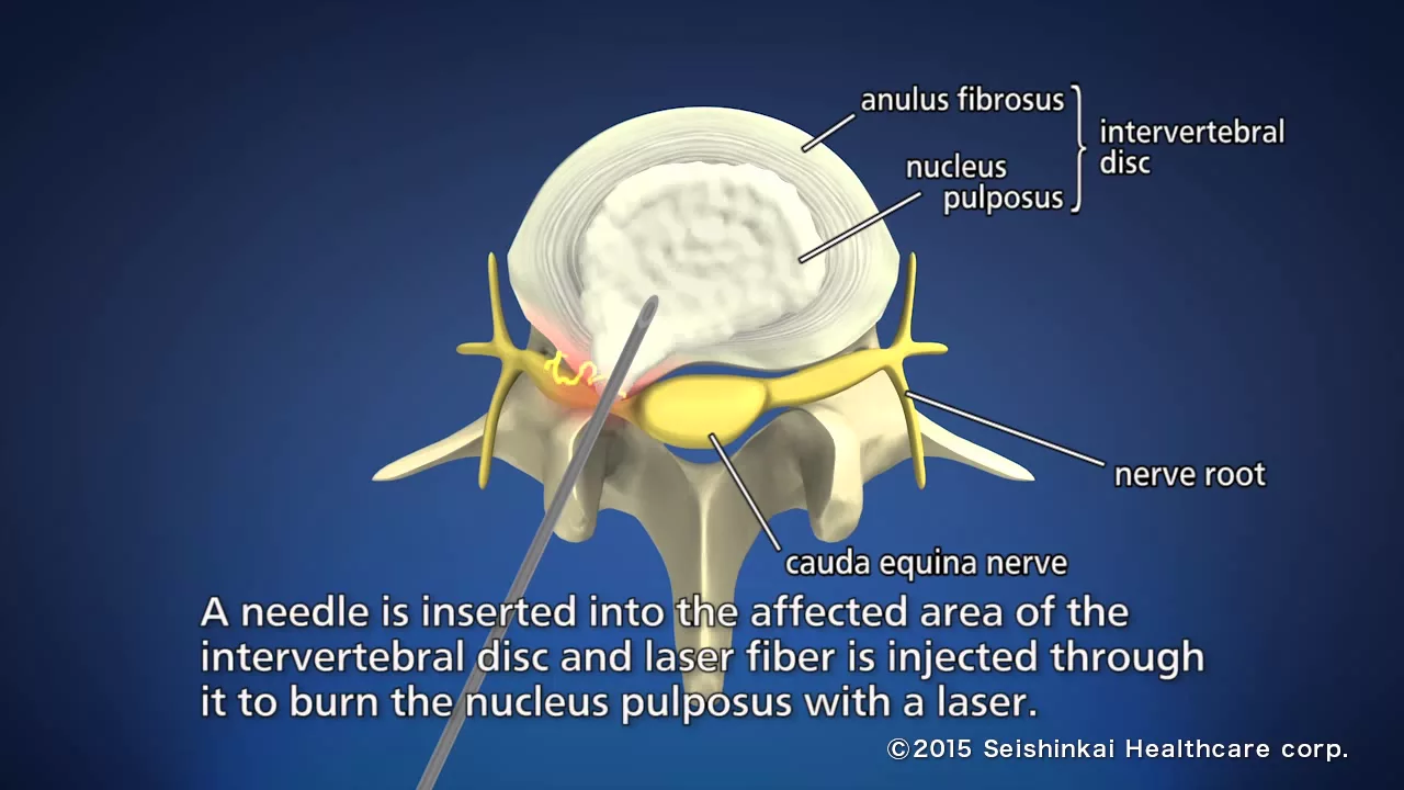Dr. Ebraheim's educational animated video describing disc herniation of the lumbo sacral spine, the . 