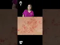 Cathy explains what petechiae are and causes of petechiae Medical Surgical SHORT LevelUpRN