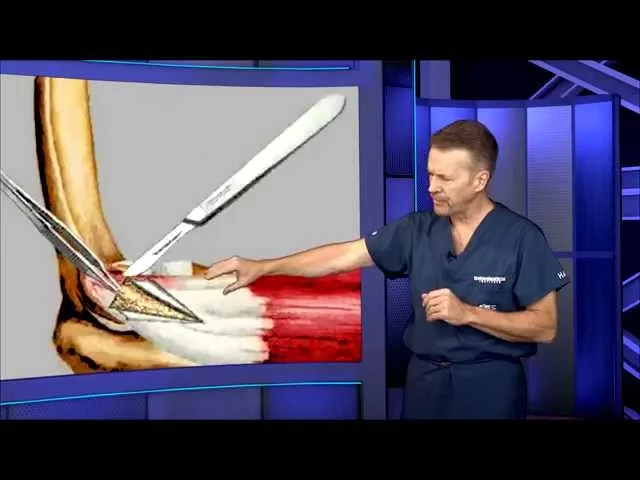 Tennis Elbow Surgery