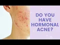 Do You Have Hormonal Acne FaceTory