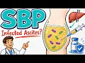 Spontaneous Bacterial Peritonitis Explained Diagnosis Treatment and Prophylaxis