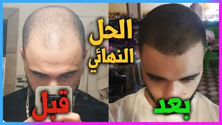 تجربتي الخاصة بعد شهرين فقط - العلاج الوحيد لتساقط الشعر و إنبات اللحية