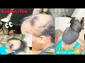 How to do a braid updo on your Alopecia client LEARN MY METHOD