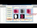 Melanoma Skin Cancer Detection Using Image Processing With Source Code Matlab Project Code