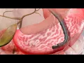 ERCP
