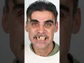 Full Smile Reconstruction with Zirconia Crowns