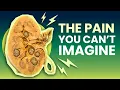 Kidney Stones The Most PAINFUL Condition on Earth