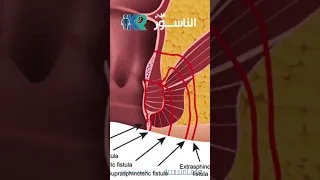 ما هو الناسور الشرجي 