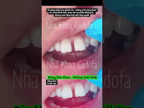 Đóng khe thưa - không mài răng #nhakhoacodofa #dentist #răngsứthẩmmỹ #veneers