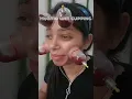 Download Lagu Hijama Cupping on face #acne #skincare #gym #motivation #shortreels #instashorts #dr.malikofficial