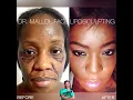 Face Liposculpting by Dr Emmanuel Mallol