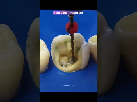 Root canal video