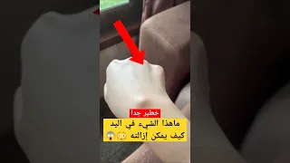 كيف تتخلص من الكيس العقدي أو الكيس الزلالي 