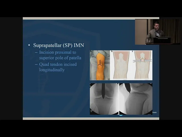 Tibial Shaft Fractures - John Callaghan, MD