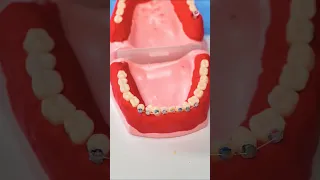 Teeth Medical Procedure Explained 3d Animation Short Video Science Education Teeth Mouths 