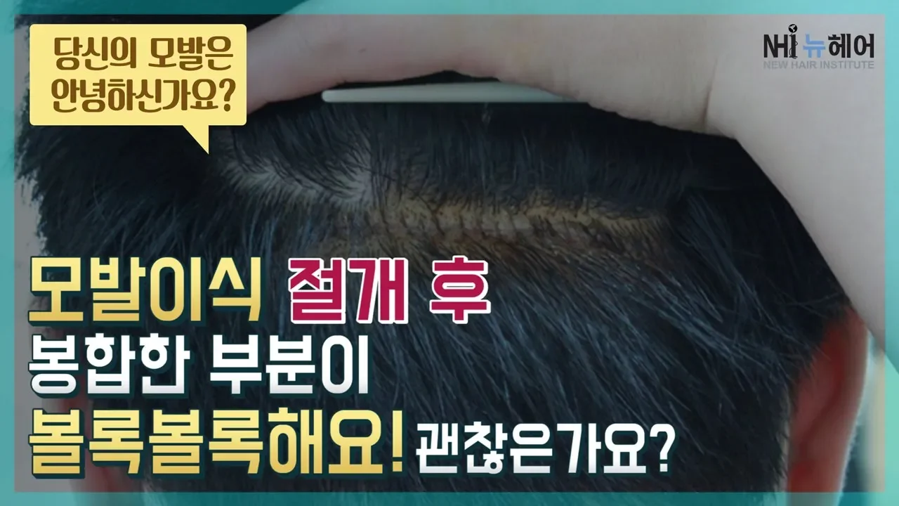 모발이식 절개후 봉합한 부분이 볼록볼록해요! 괜찮은건가요? (당신의 모발은 안녕하신가요?)