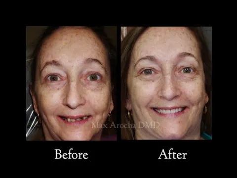 Costs For Dental Implants Oakland Park Florida