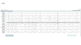 Download EEG Atlas B3: Understand EEG Through Examples With The Ceribell Rapid Response System MP3