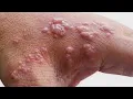 How the monkeypox virus spreads from person to person