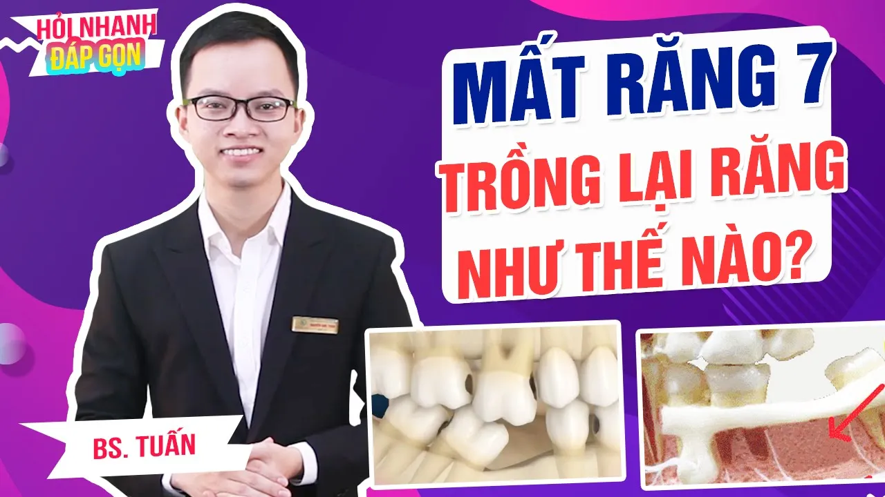 Outline Video Mất răng hàm số 7 trồng lại thế nào | Chi phí bao nhiêu