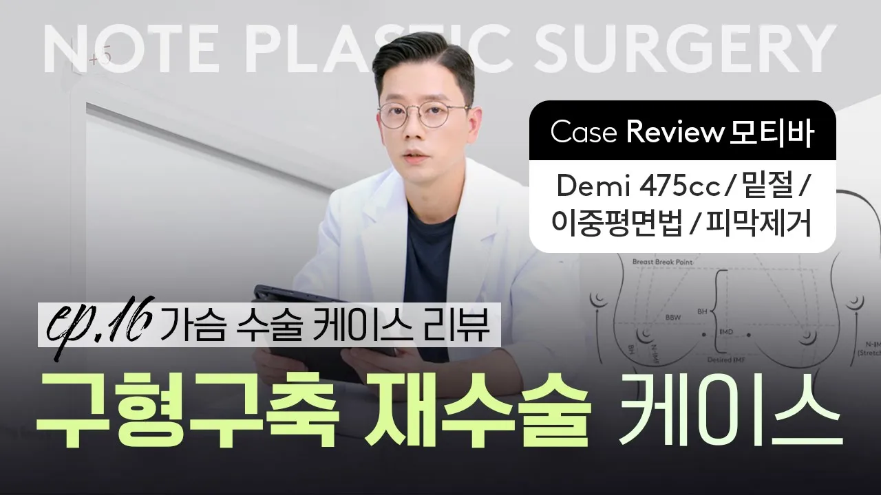 [가슴수술 리뷰] 구형구축 l 두번째 재수술 l 피막 제거 l 모티바 가슴성형 l  노트성형외과