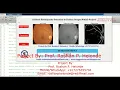 Diabetic Retinopathy Detection Using Image Processing Matlab Final Year IEEE Project Code