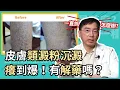 Download Lagu 皮膚類澱粉沉澱，又黑又癢，最新治療方法大公開！